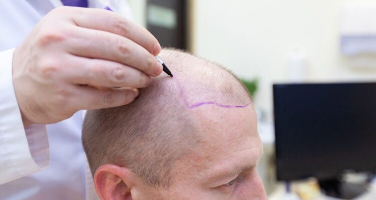 What are the Limitations involved with FUE Hair Transplant