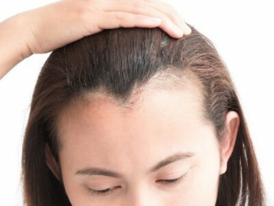 When a (Corrective) Revision Hair Transplant recommended on the Hair Transplant