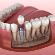 Dental Implant Queens: The Complete Guide to Your New Smiles Dental Implant Queens