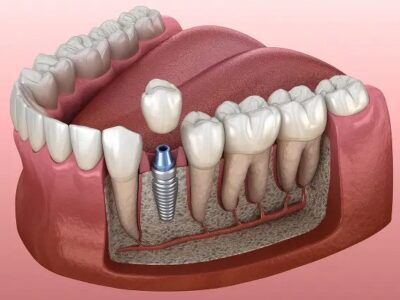 Dental Implant Queens