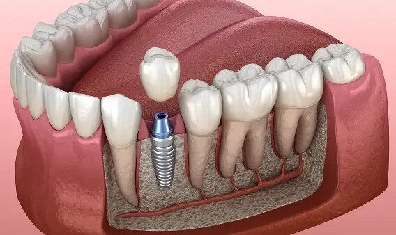 Dental Implant Queens
